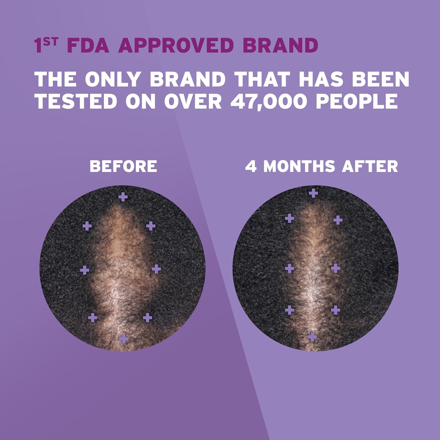 Rogaine 5% Minoxidil Foam for Women – Topical Once-A-Day Hair Loss Treatment – R