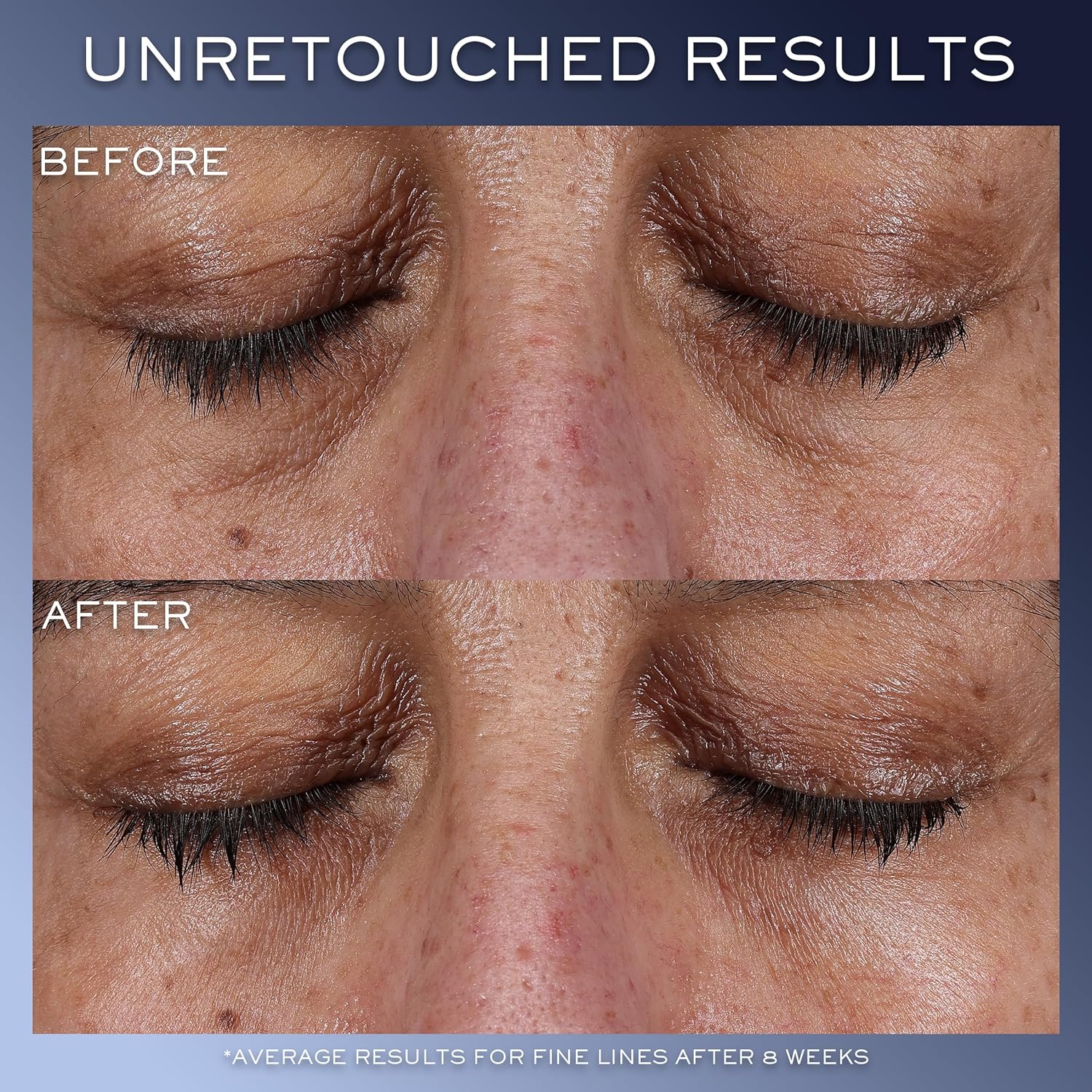 Lancôme Génifique Eye Cream – Reduces Dark Circles & Fine Lines with Bifidus Pre