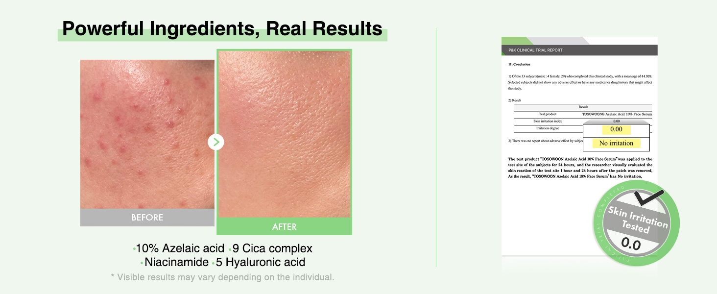 TOSOWOONG Azelaic Acid 10% Face Serum – Redness Soothing, Rosacea & Blemish Care banner 2